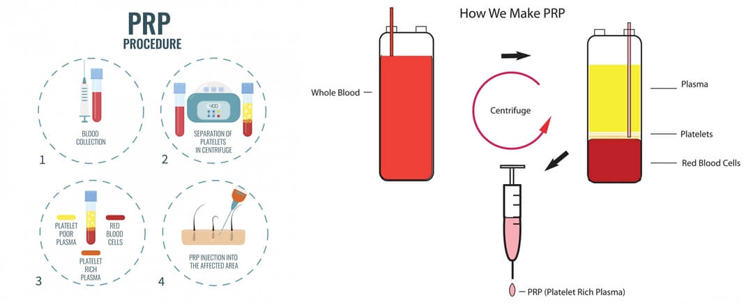 PRP Centrifuge Procedure - PRP Centrifuge