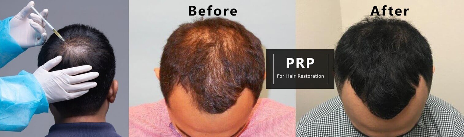 PRP used for Hair Loss - PRP Centrifuge