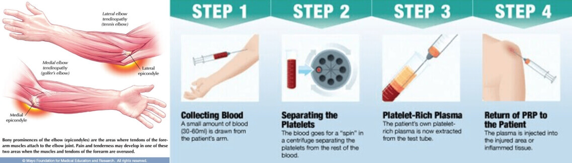 PRP used for Tendon injuries - PRP Centrifuge