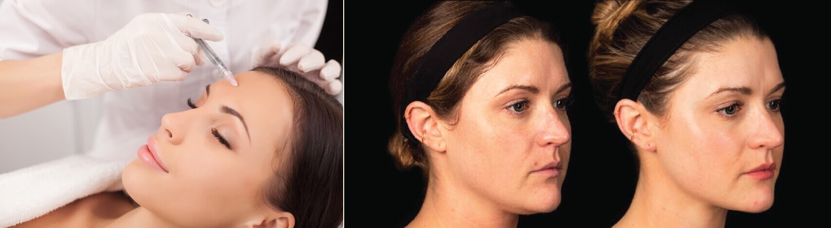 PRP used for skin rejuvenation 1 - PRP Centrifuge