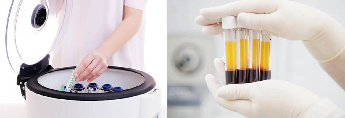 What Is PRP Centrifuge - Different Types of Centrifuges, Functions, Uses and Prices, How to Choose?